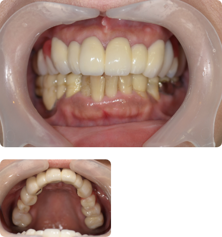 重度歯周病の症例